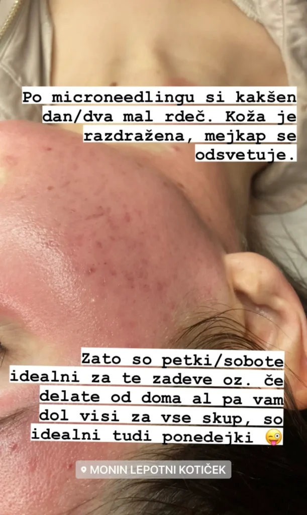 microneedling ljubljana