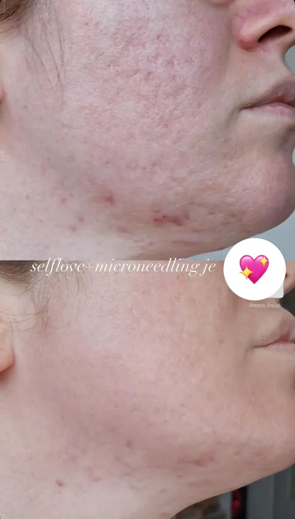 microneedling cena tretma obraz Ljubljana