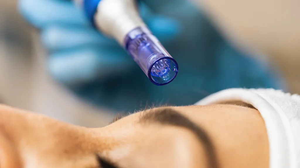 Microneedling cena