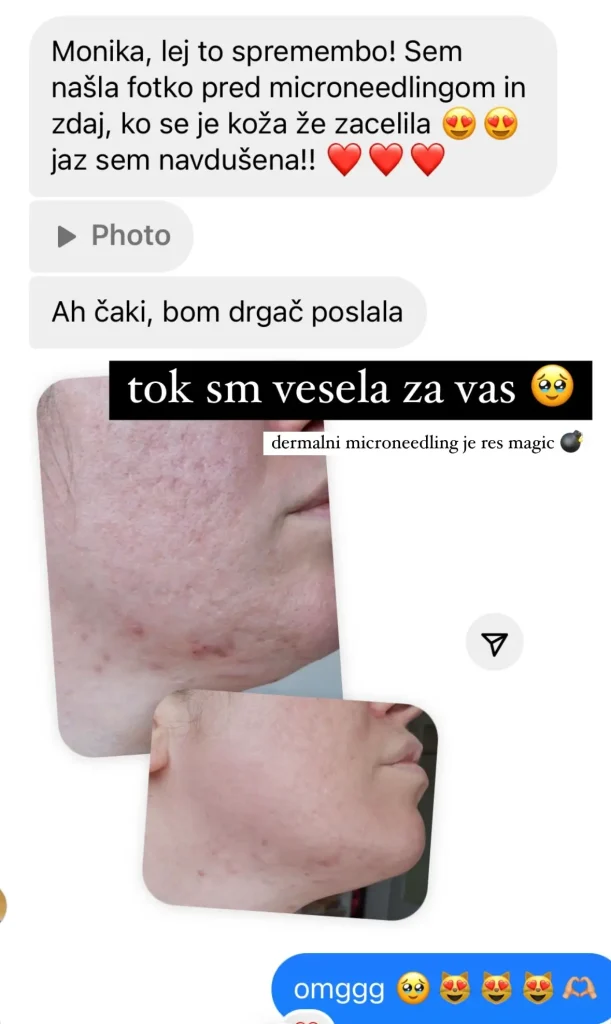 Microneedling Ljubljana